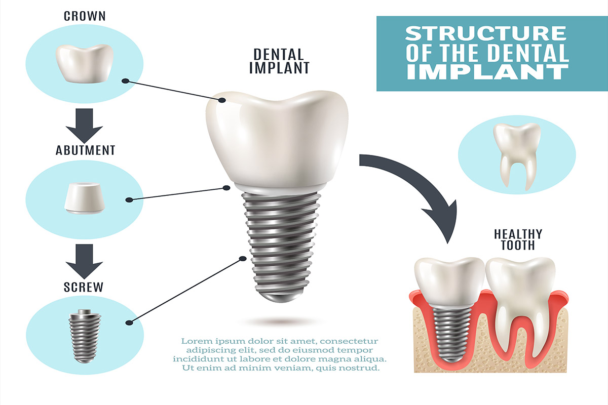 Dental Implant 3