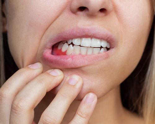 Gum Treatment