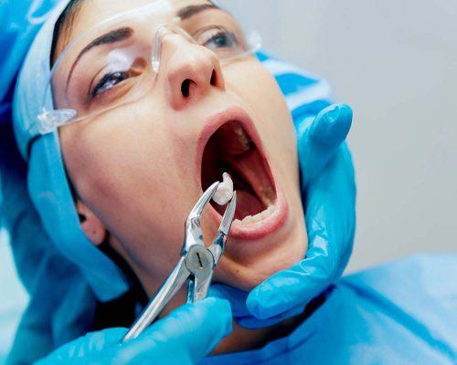 Wisdom Tooth Removal